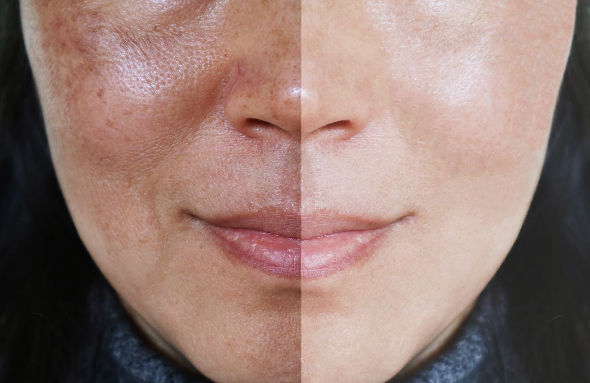 5 formas de tratamento para o melasma