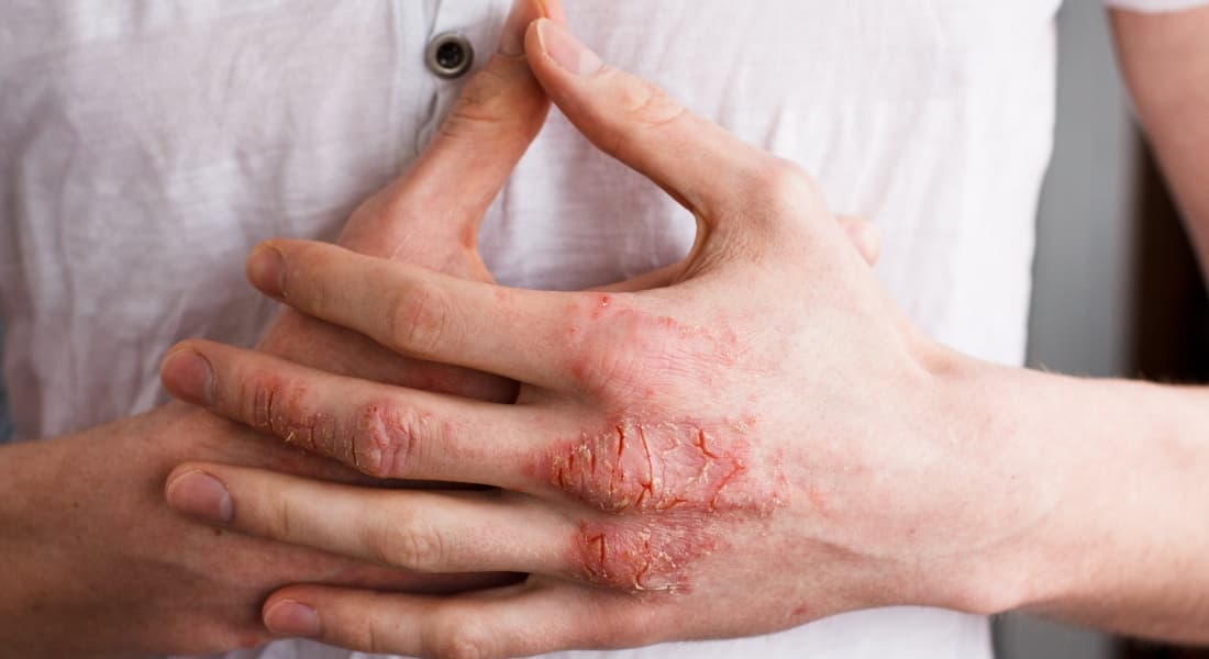Dermatite atópica: o que é, sintomas, tratamentos e tem cura?