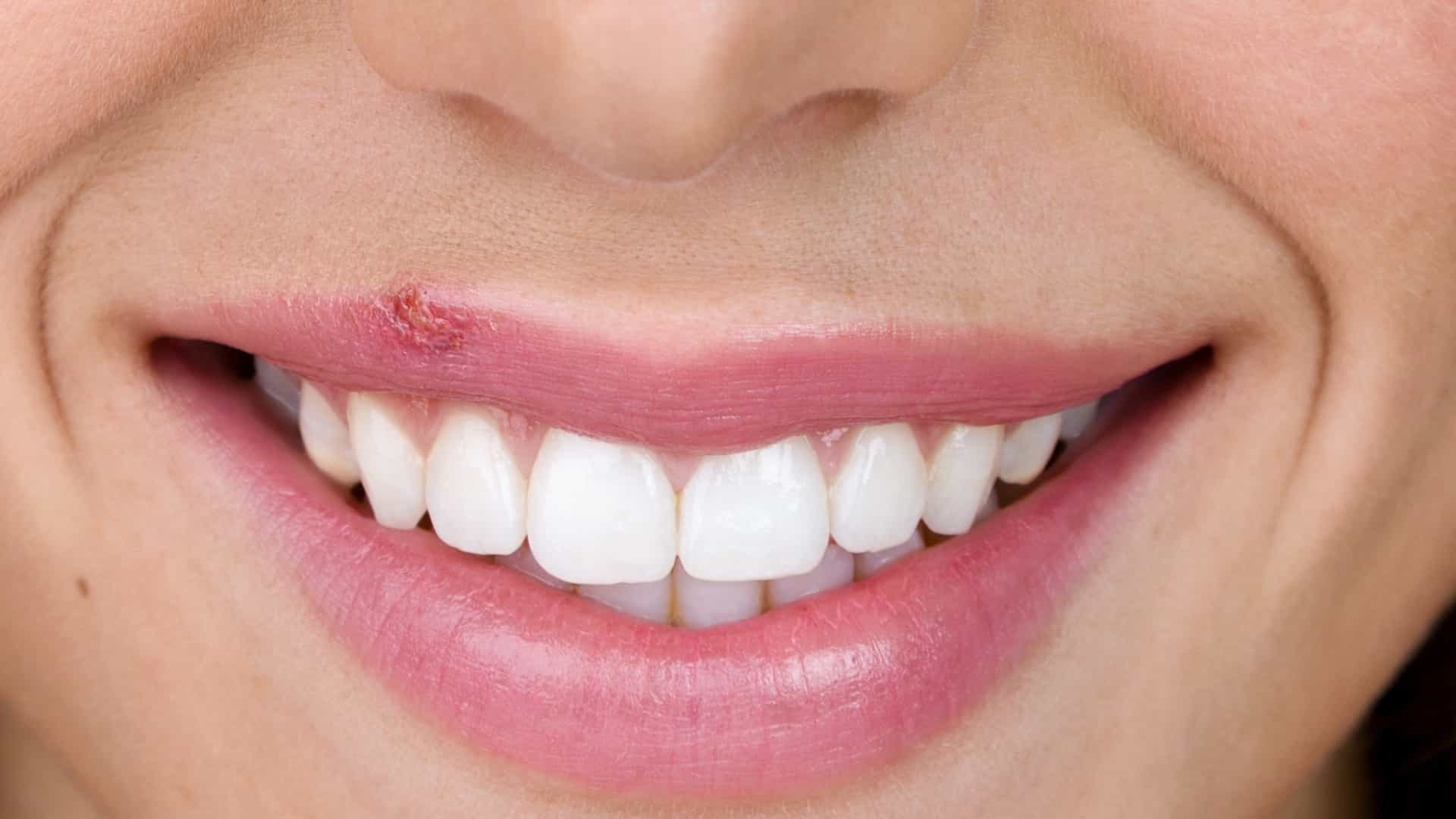 Herpes labial: o que é, como prevenir e tratar
