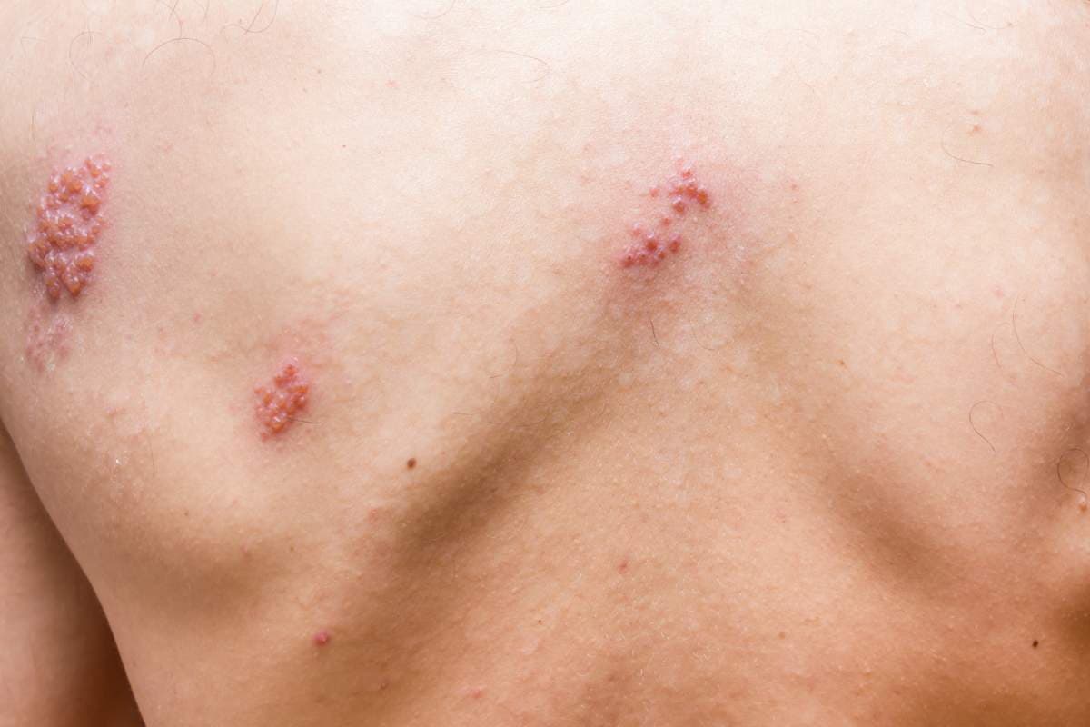 Vacina do herpes zoster: saiba quando tomar