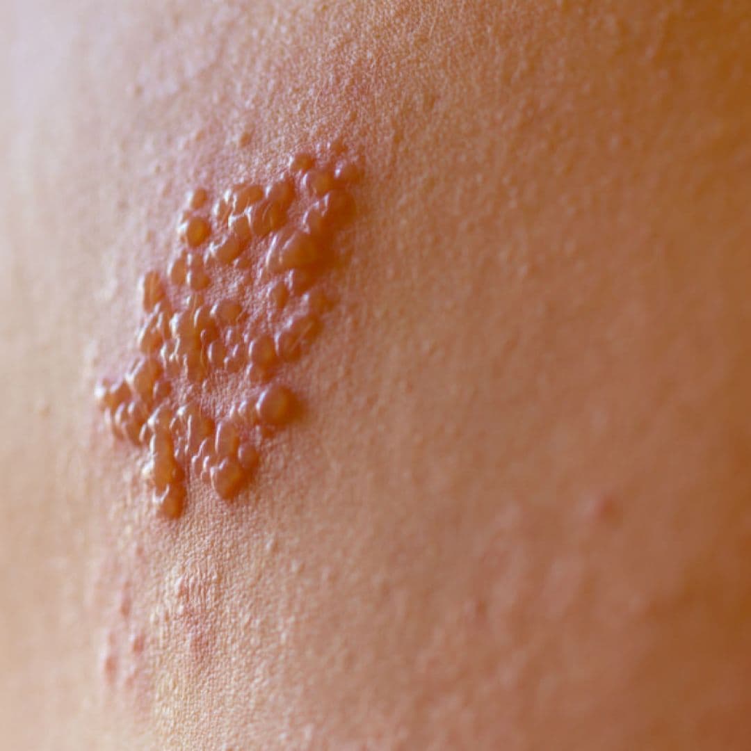 Herpes zoster: o que é e como tratar