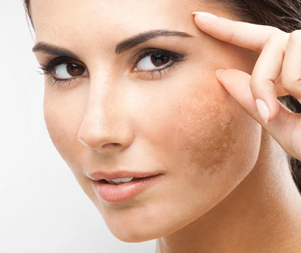 Manchas na pele, no rosto, no corpo: conheça os tipos, cores, como clarear e saiba como prevenir essas marcas