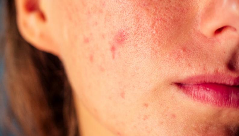 Acne da mulher adulta: o que é, causas e tratamentos