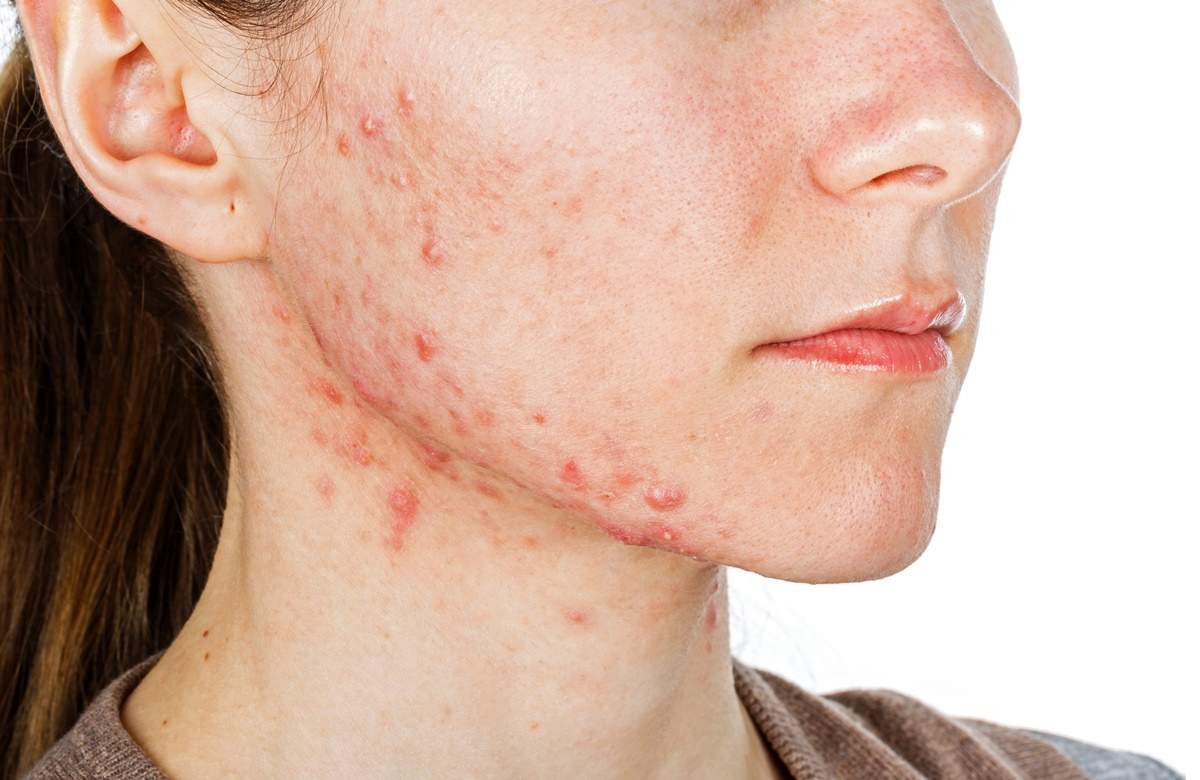 Acne em mulheres adultas? Guia para tratar