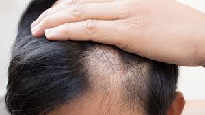 Alopecia areata: o que é, como tratar