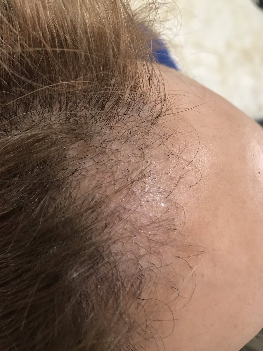 Alopecia fibrosante frontal: o que é, sintomas e tratamentos