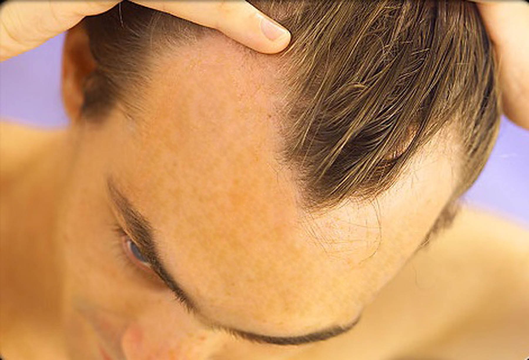Calvície e queda de cabelo