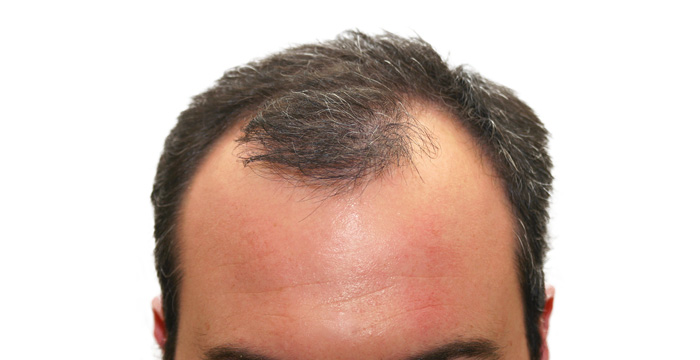 É possível prevenir a calvície masculina? Saiba tudo