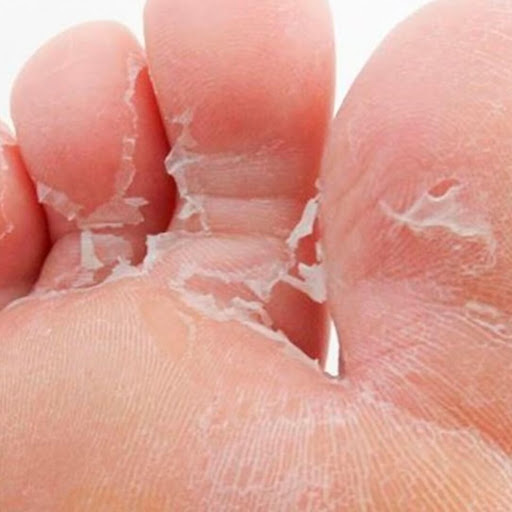 Frieira e fungos nos pés: como tratar e prevenir