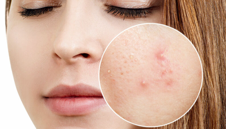 Má alimentação favorece o surgimento da acne