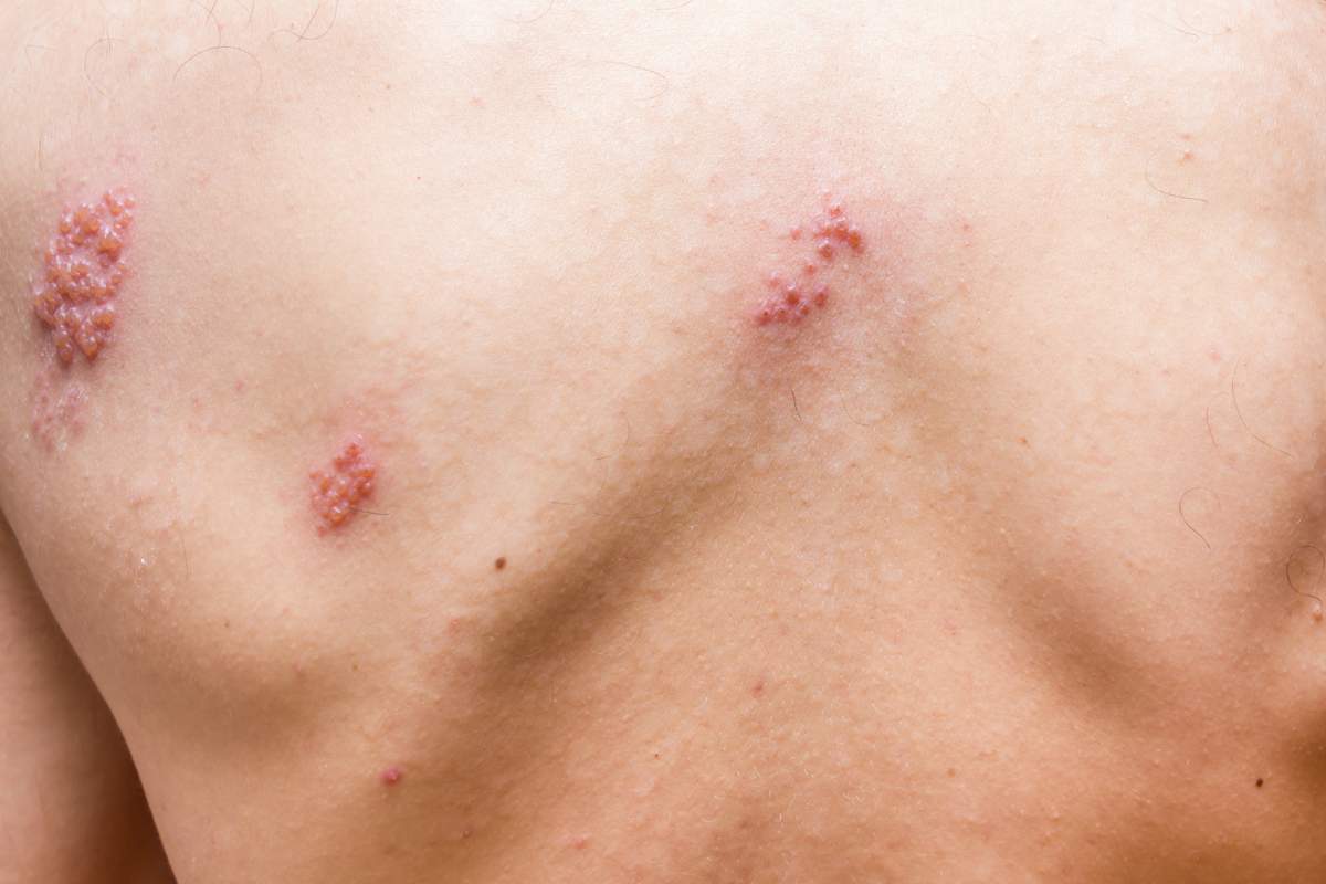 Vacina do herpes zoster: saiba quando tomar