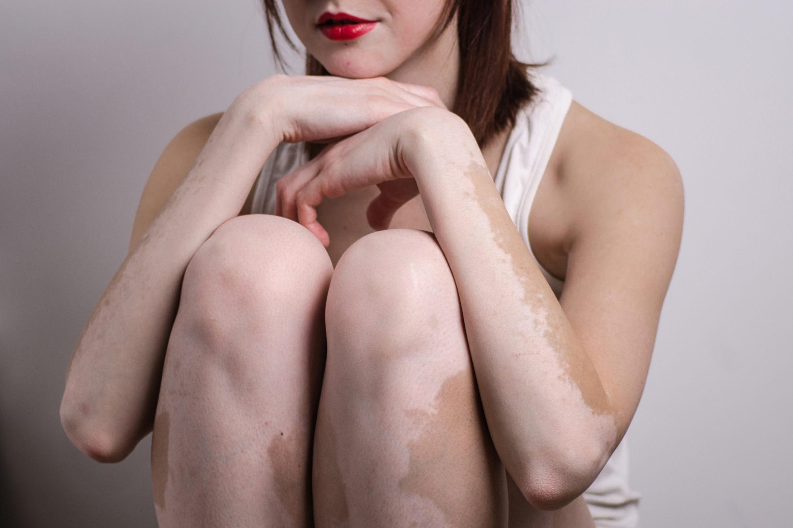 Vitiligo: o que é, sintomas e como tratar