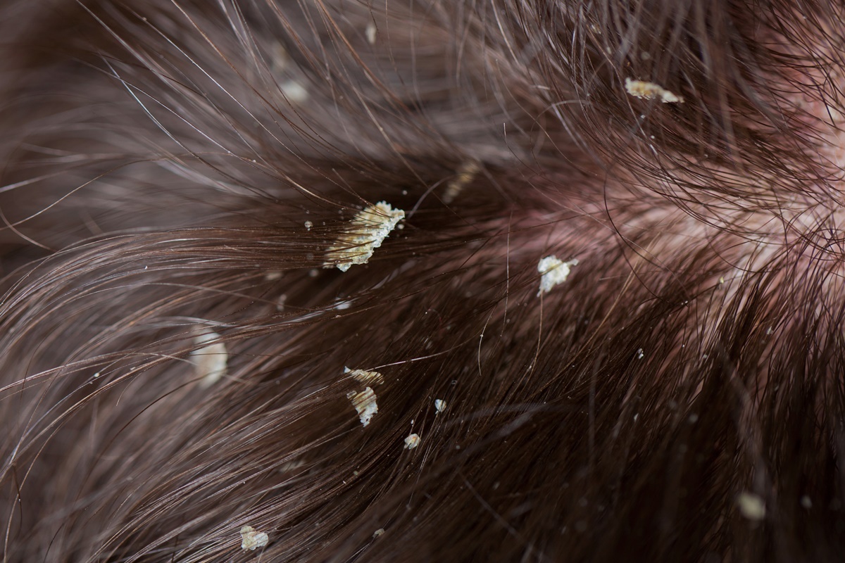 DERMATITE SEBORREICA E CASPA: O QUE É, SINTOMAS E COMO TRATAR