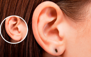 furo orelha alargada - lobuloplastia