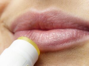 herpes como prevenir