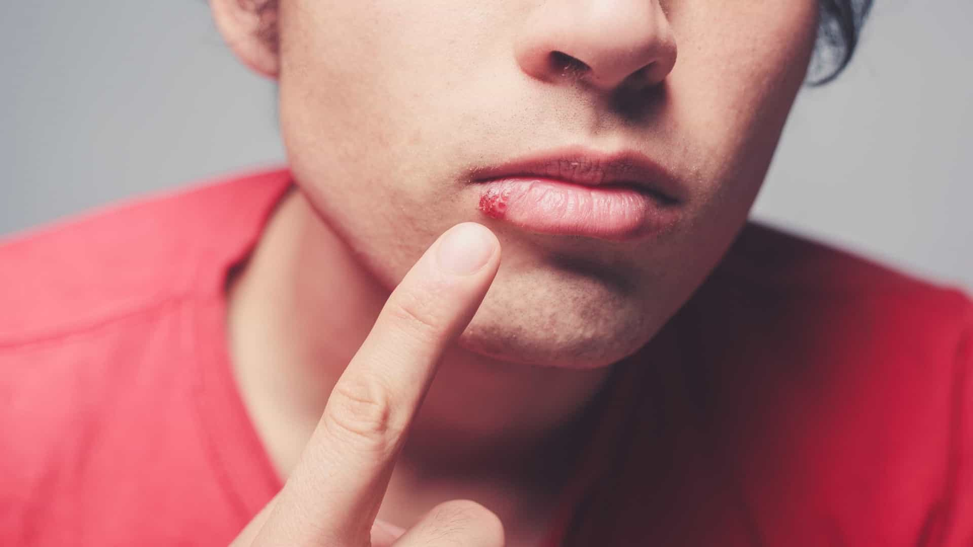 herpes labial alimentos que melhoram ou pioram