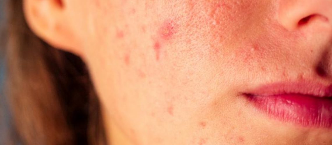 ACNE-DA-MULHER-ADULTA-TRATAMENTO-DERMATOLOGISTA-IPANEMA-BARRA-MARIANA-RITA-FERNANDES