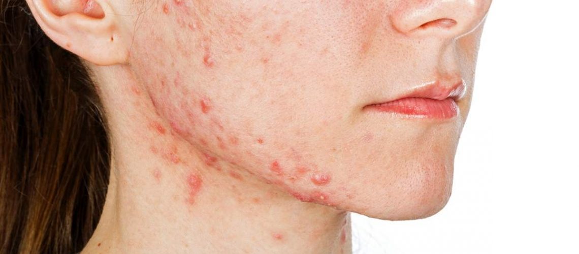 Acne em mulheres adultas? Guia para tratar