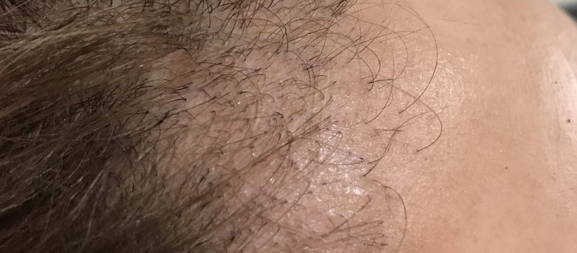 ALOPECIA FIBROSANTE FRONTAL: O QUE É, SINTOMAS E TRATAMENTOS