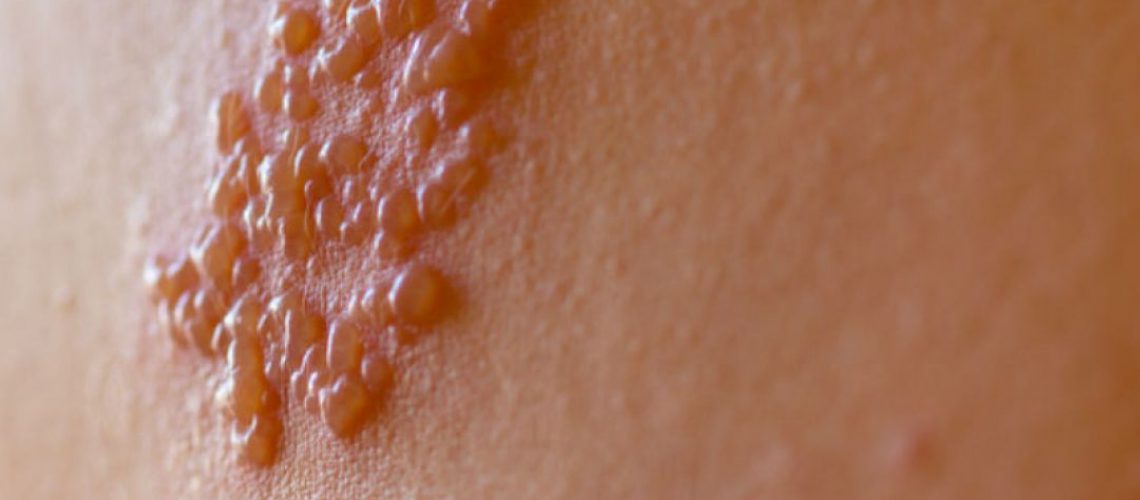 herpes zoster o que é e tratamento